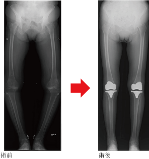 手術前後の単純X線像（人工膝関節全置換術）