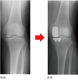 手術前後の単純X線像（人工膝関節単顆置換術）