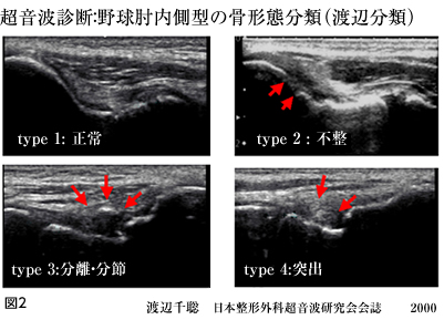 超音波診断：野球肘内側型の骨形態分類（渡辺分類）