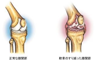 膝関節の病気