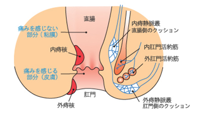 痔核の図説